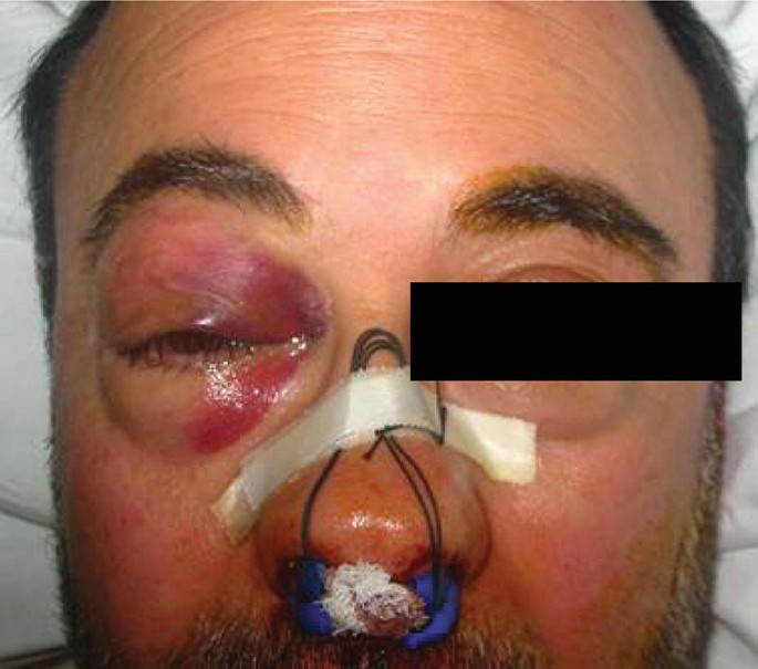 A photograph of the face of a patient. The eyes are swollen and reddened. The left eye is covered. The nostrils are plugged. A marking is made on the nose, and tape is present in the nose horizontally.