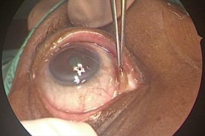 A photograph of the forceps retracting the caruncle of the right eye.