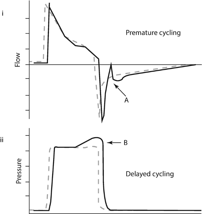 A graph on flow and pressure. The flow graph for premature cycling starts parallel to the y-axis, gradually decreases to the negative axis, peaks, and then increases till it reaches the positive x-axis. The delayed cycle for pressure has a rectangular curve with a positive trend.