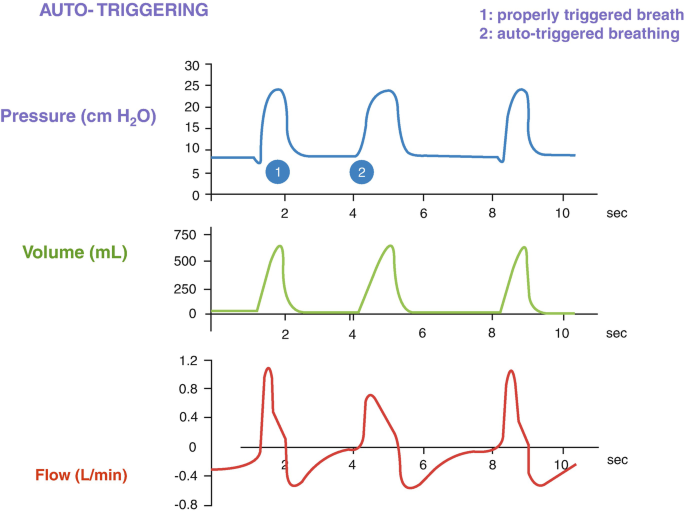 3 waveforms on auto-triggering are pressure, volume, and flow. Triggered breathing is prompted by a low, projecting peak, and breathing is also automatically triggered at point 2. The volume graph has triangular peaks. The flow graph has crests and troughs. The time axis is for 10 seconds.