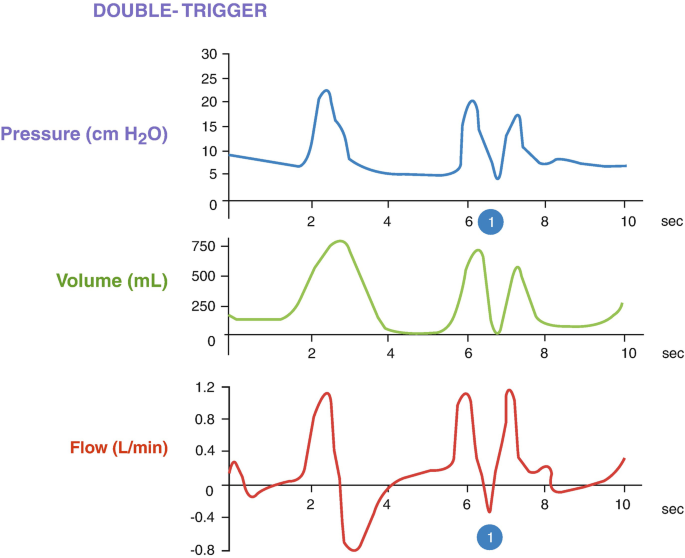 3 waveforms on the double trigger are pressure, volume, and flow. The pressure graph has 3 triangular peaks. The volume graph has triangular peaks. The flow graph has crests and troughs. The time axis is for 10 seconds.