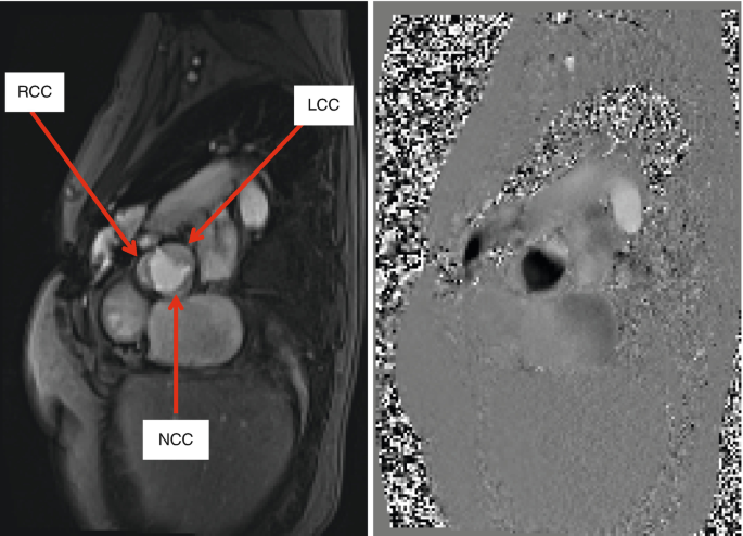 2 frames of M R I scan of the aortic valve. 1, presents the gradient echo imaging technique with labels R C C, L C C, and N C C. 2, presents the velocity mapping of the aortic valve with trileaflet valve.