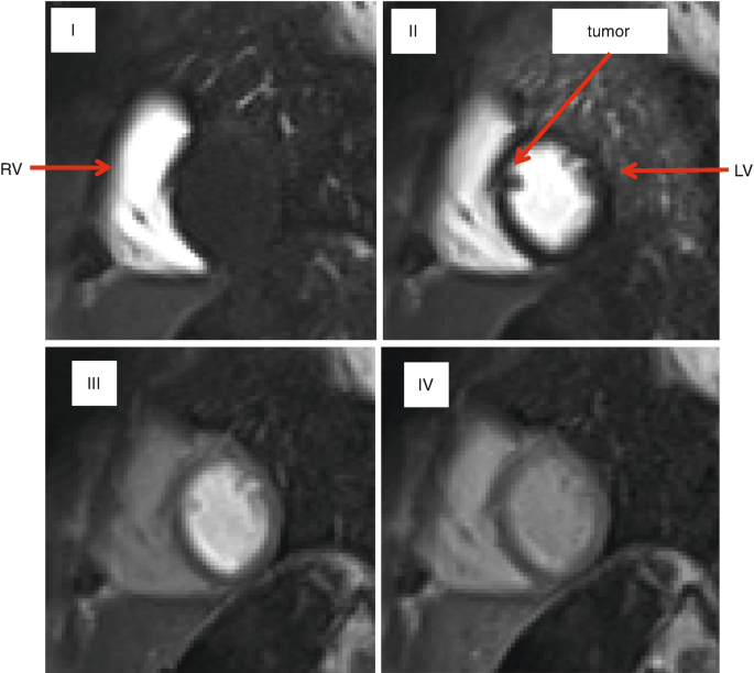 4 frames of M R I scan with perfusion imaging. 1, present the R V cavity. 2, presents the L V cavity and a tumor. 3 and 4, present the L V myocardium where the cavity is indistinguishable from the tumor.