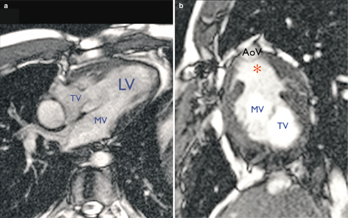 2 S S F P, M R imaging scans present D I L V. A, demonstrates the 4-chamber view with labels L V, T V, and M V. B, presents outflow chamber around A o V, and M V and T V are labeled.