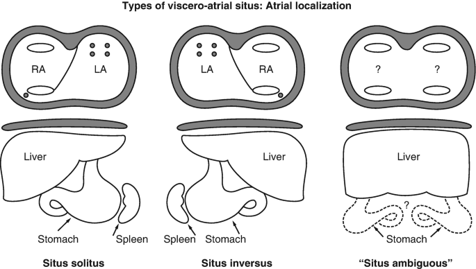 3 illustrations of atrial localization of viscero-atrial situs. The labels mentioned are R A, L A, liver, spleen, and stomach. 1, presents situs solitus. 2, presents situs inversus. 3, presents situs ambiguous.