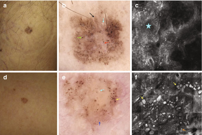 congenital lingual melanotic macule Frontiers main image 0