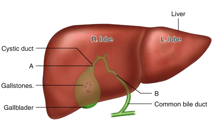 Flank pain radiating to the suprapubic region