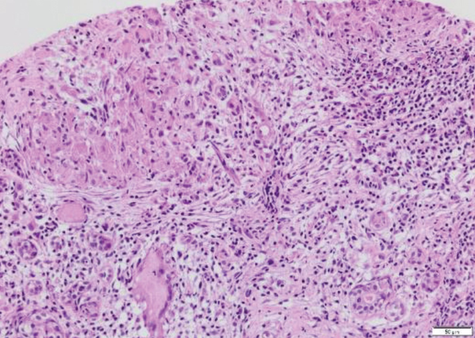 A histological study of tissue has a closely packed cluster of cells, with shaded spaces between the cells. It has shaded areas of varying sizes between the cells.