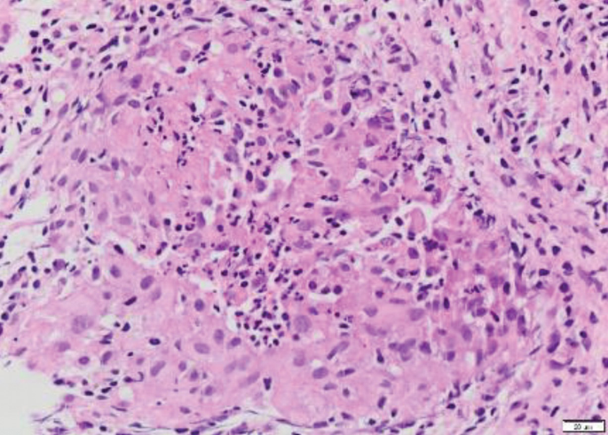 A histological study of tissue has a few dense, shaded spaces between the cells. It has multiple colored spots and a few white spaces between the cells throughout the slide.