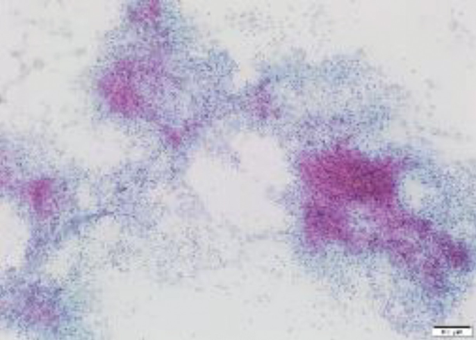 A histological study of tissue has a few dark-shaded dense clusters of cells, with prominent ones towards the center, left, and right sides of the slide. The slide and the cell cluster have minute dots without clear cell boundaries.