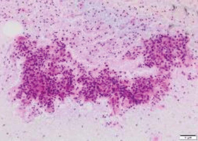 A histological study of tissue has a dark-shaded dense cluster of cells towards the center of the slide. It has multiple closely packed colored spots within the cluster and throughout the slide, with maximum spots at the top part of the slide.