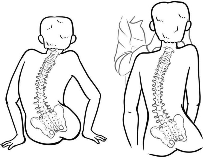 Neuromuscular Scoliosis | SpringerLink