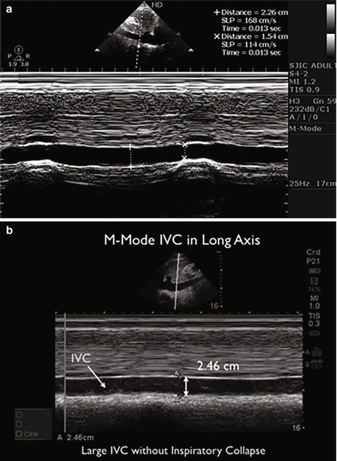 Hemodynamic Instability Spotted Sooner With Continuous Noninvasive BP  Monitors