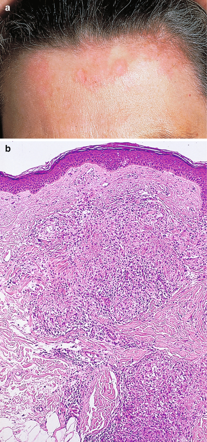 Ulceration of Breast's Skin due to Topical Corticosteroid Abuse - Open  Access Pub