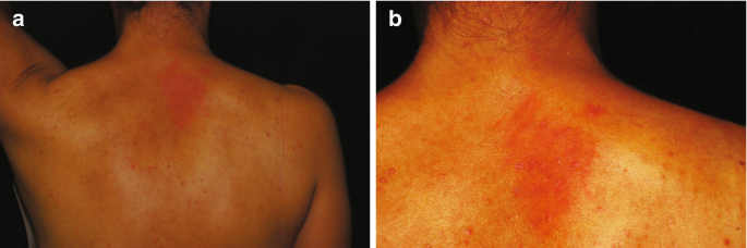 Two photographs of a skin condition, namely malassezia, on the back of the patient.