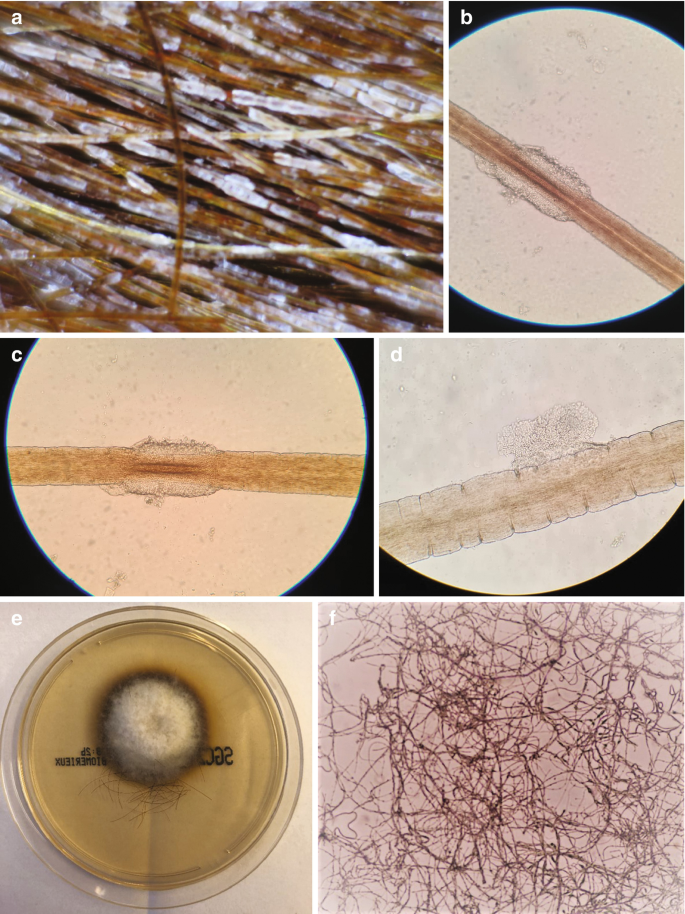 Six photographs of the white piedra. A, b, c, and d show the nodules surrounding the hair shaft. E represents the crumb like structure. F shows the short chains.