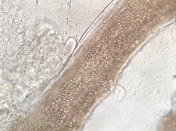 A microscopic scan of the endotrich infection.