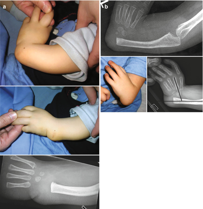 Ulnar Longitudinal Deficiency (Ulnar Club Hand)