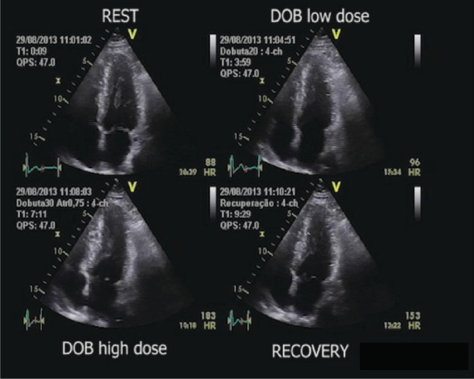 4 echocardiograms in 2 panels. The 4-chamber views present the upper panel during rest and D O B low dose. The lower panel displays the images during D O B high dose and recovery.