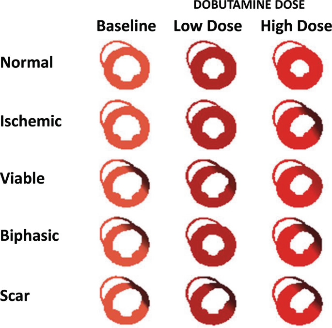 An illustration with 3 columns and 5 rows. It presents the myocardial responses to dobutamine dose. The columns are labeled baseline, low dose, and high dose. The rows indicate normal, ischemic, viable, biphasic, and scar.