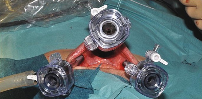 A photograph of the incision and the insertion of 3 trocars in the vestibule during surgery on a person.