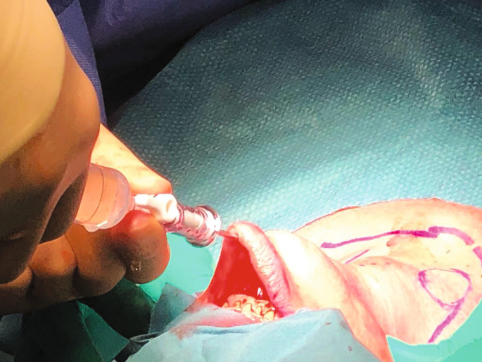 A photograph of the insertion of a Veress needle in the vestibule during surgery on a person.