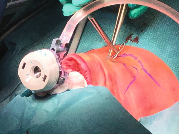 A photograph of the insertion of a trocar in the vestibule during surgery on a person.