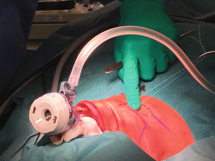A photograph of the retraction of muscles after the insertion of the trocar during surgery on a person.
