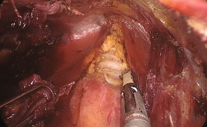 A laparoscopic image of the thyroid gland.