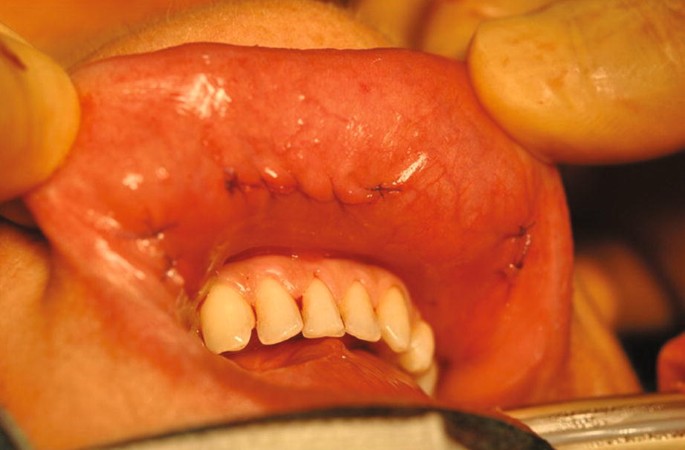 A photograph of sutures on the inner part of the lower lip of a person.