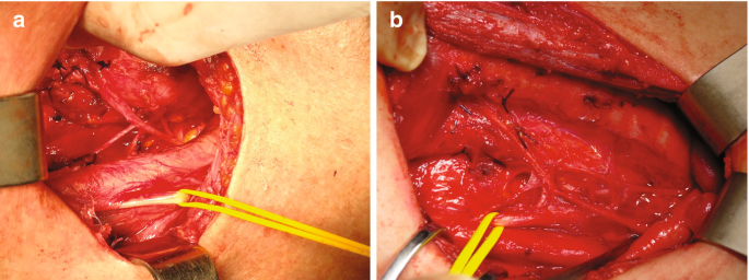 Two close-ups of the superior cervical sympathetic ganglion connected with the R L N and a large S I L A B connecting an N R-I L N with the sympathetic chain are labeled a and b, respectively.