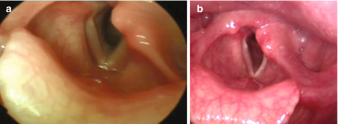 Two photographs of laryngoscopy evaluation after autologous fat injection. The evaluations are recorded after three and six months and are labeled a and b, respectively.