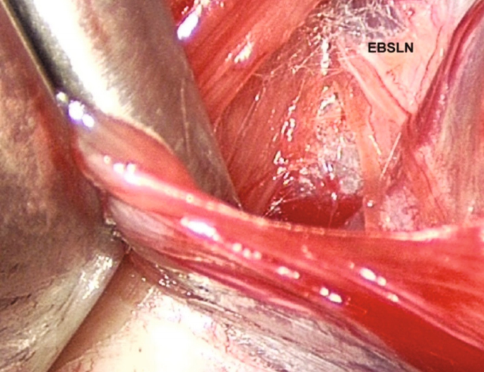 An endoscopic image of the external branch of the superior laryngeal nerve.