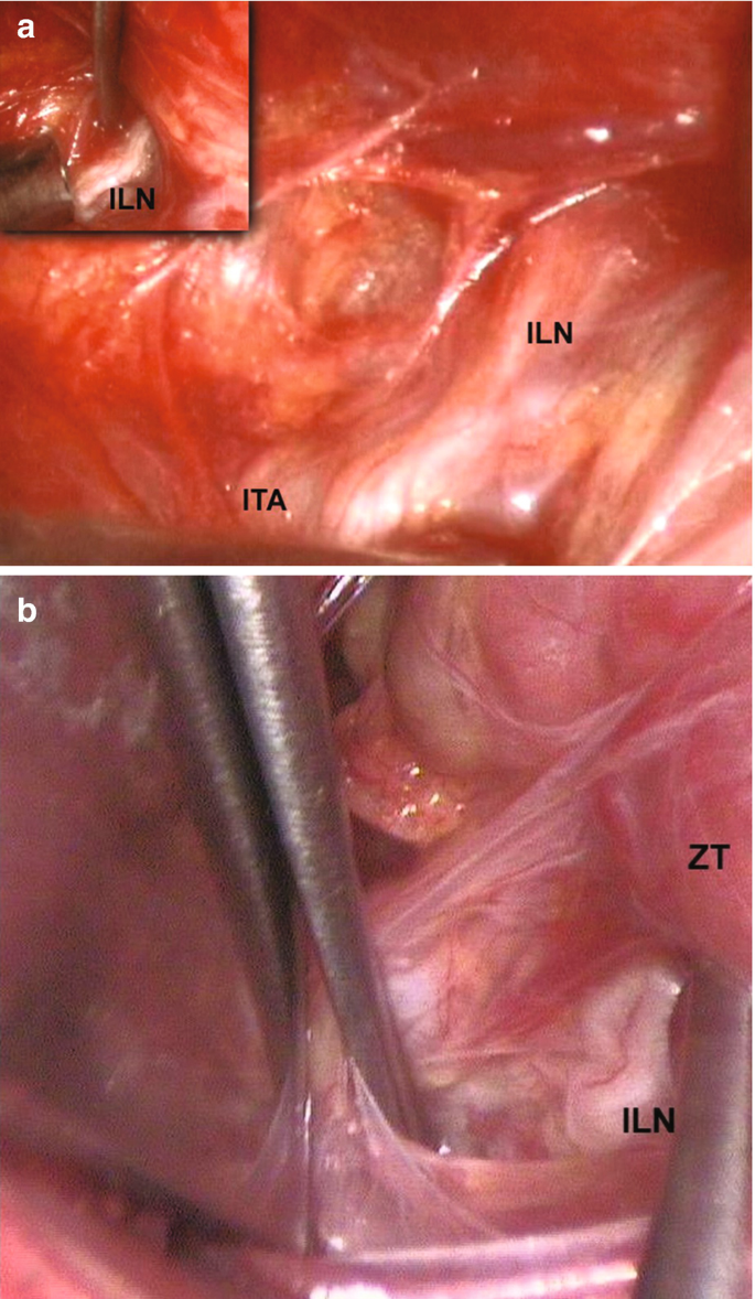 Two endoscopic images. a. Inferior laryngeal nerve and inferior thyroid artery with an inset image of the inferior laryngeal nerve. b. Zuckerkandl tubercle and inferior laryngeal nerve.