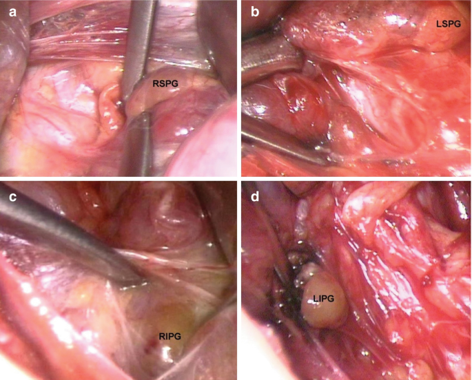 Four endoscopic images. a. Right superior parathyroid gland. b. Left superior parathyroid gland. c. Right inferior parathyroid gland. d. Left inferior parathyroid gland.