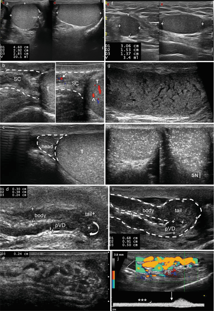 10 Doppler ultrasounds. A, Normal testis with ellipsoid shape. B, spermatic cord structures. C, Normal epididymal head. D, body, tail, and proximal vas deferens. E, Normal pampiniform plexus. F, Hypoechoic testis with low volume. G, inhomogeneous testicular echotexture. H, testicular microlithiasis. I, dilated and inhomogeneous epididymal structures with a mass in the tail region. J, Severe varicocele with continuous reflux at rest and increased flow with Valsalva.