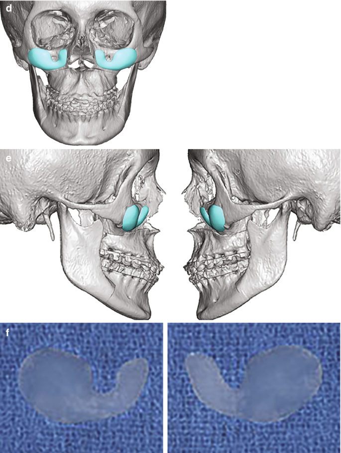 Custom CT Scanned Implants  Custom Facial Implants New York