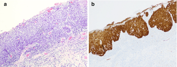 2 immunohistochemistry images. A is hematoxylin and Eosin-stained with scattered cells. B depicts the p 16 structures.