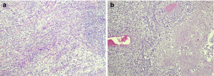 2 stained images of sarcomatoid carcinoma. A cluster of cells spread throughout is visible. The squamous cell carcinoma structure is visible in B. A spindle-shaped cell is visible in b.