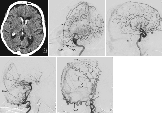 A C T scan of a patient with intraventricular hemorrhage and a set of 4 D S As of the complex d A V F. The supplying arteries labeled are as follows. In a, S S S, P E t A, O A, and A E t A. In b, M T A. In c, P M A. In d, S T A, M M A, and O c c A.