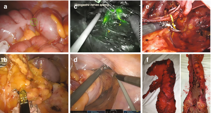 6 intraoperative photos. Some masses and fat are present. The portion of the splenic flexure is pulled out. Three ports are inserted, and the lymph node is placed. Removed masses are kept on the surface.