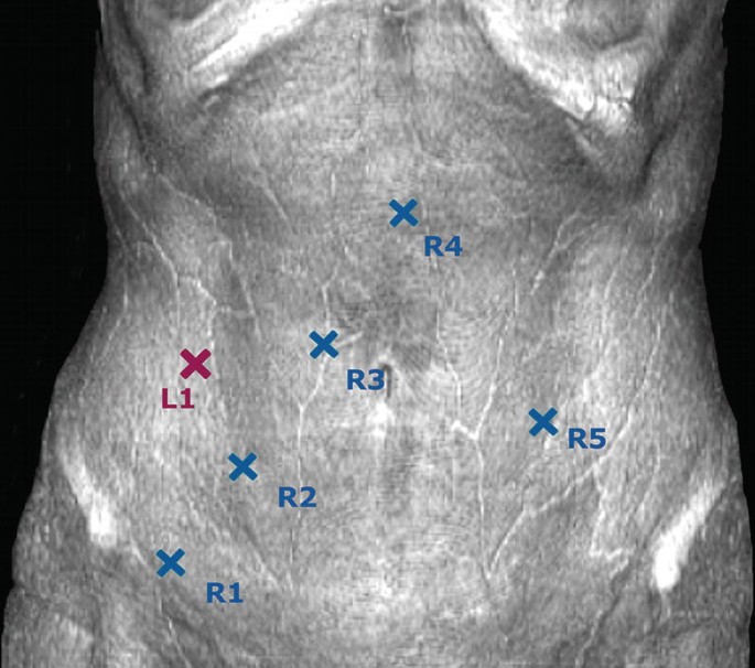 A photograph of the abdomen region. It has 6 ports. Ports R 1, R 2, R 3, and R 4 represent a linearly increasing trend. R 4 lies on the midline and R 1 on the lower right pelvic region. L 1 and R 5 are on the right and left abdomen.