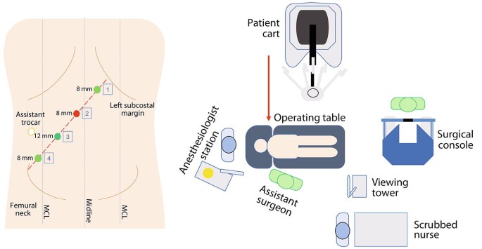 2 diagrams. On the left is the abdomen with midline and M C Ls. A linearly increasing line has 4 ports. An assistant trocar port is on the right abdomen. On the right is an operation set-up with an operating table, anesthesiologist station, assistant surgeon, surgical console, and viewing tower.