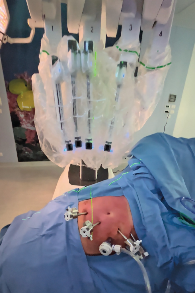An intra-operative photograph of the abdomen of a patient. A tip-up grasper, monopolar scissors or robotic stapler, a camera, and bipolar forceps are inserted in the abdomen in a line. A laser step-up is present on the top of the patient. 4 laser beams fall on the positions of the ports from above.