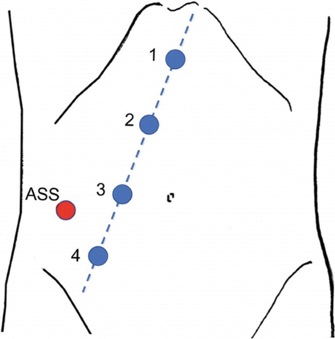 A diagram of the abdomen region. It represents 4 ports on a slanting line at the right abdomen. The ports are labeled 1, 2, 3, and 4. An assistant port A S S is present near ports 3 and 4.
