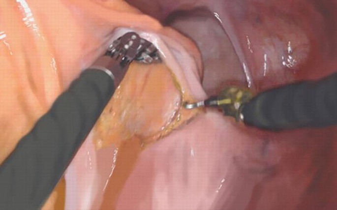 An intra-operative photograph of the rectum area during surgery. 2 tip-up graspers retract the recto-sigmoid junction. The right lateral peritoneum is divided.