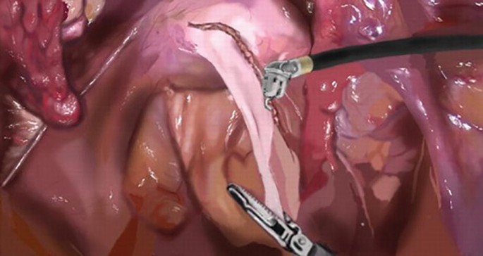 An intra-operative photograph of the rectum area during surgery. A monopolar hook makes a peritoneal incision curve in J-shape at the level of the pouch of Douglas. A grasper retracts the membrane.