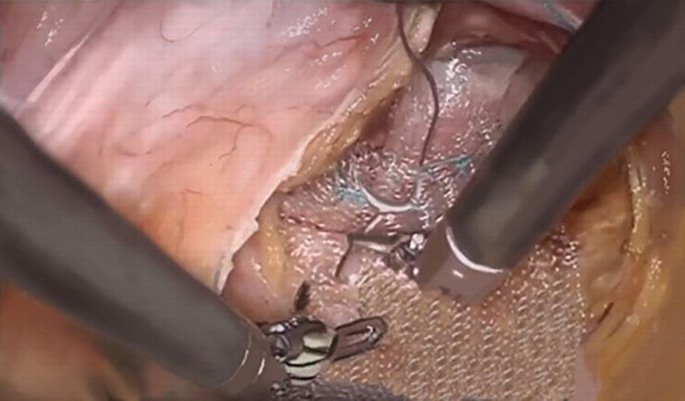 A photograph of the inner view of the abdomen area during surgery. 2 trocars place a polypropylene mesh at the anterior distal rectum. Sutures are done to fix the mesh.