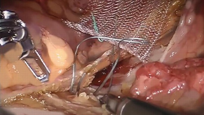 A photograph of the inner view of the abdomen area during surgery. A polypropylene mesh is placed on the right side of the rectum. 2 trocars do the sutures with suture thread to fix the mesh.