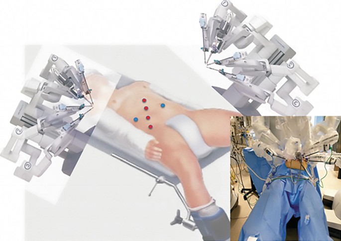 A 3 Dimensional illustration and a photograph. It presents the supine position of the patient along with the trocar positions marked in the abdominal region. The needle-shaped instruments are projected toward the target position from the top.